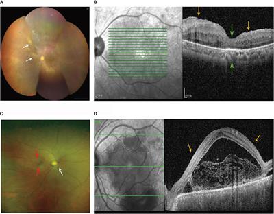 Association Between Interleukin 35 Gene Single Nucleotide Polymorphisms and the Uveitis Immune Status in a Chinese Han Population